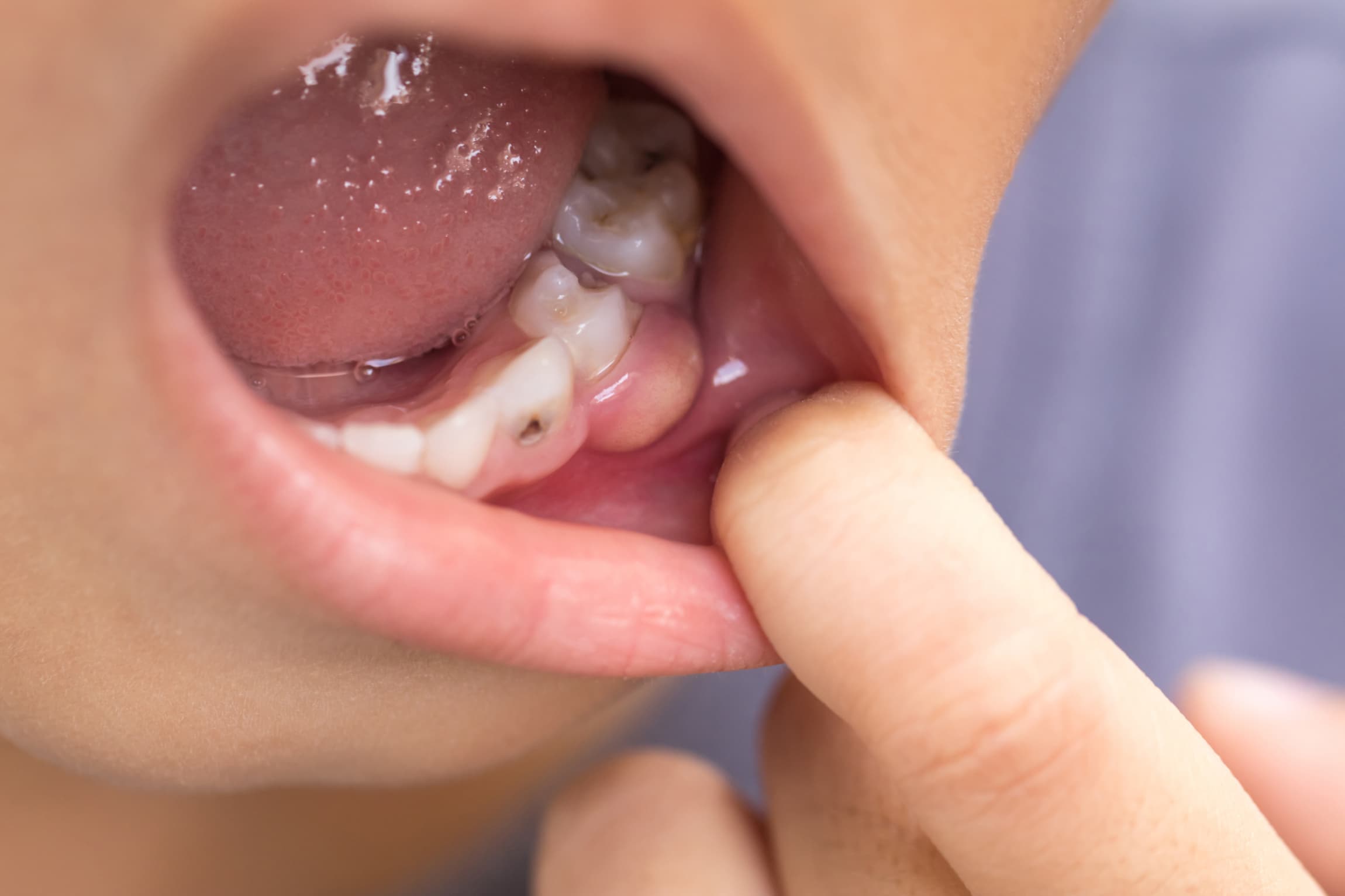 ¿Qué es el tratamiento de pulpotomía en los niños?