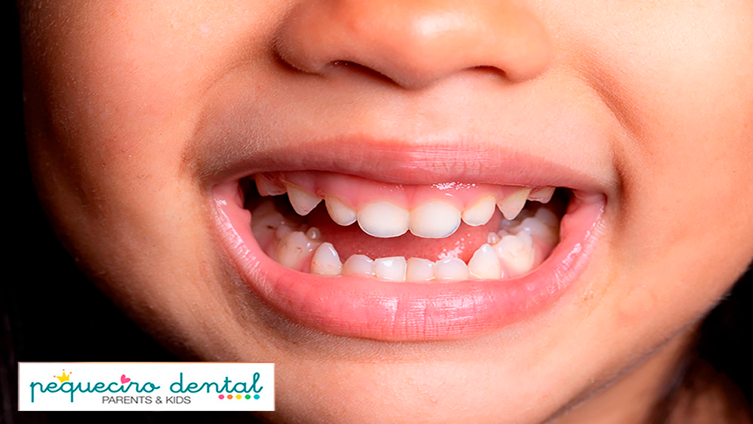 caries-infantiles