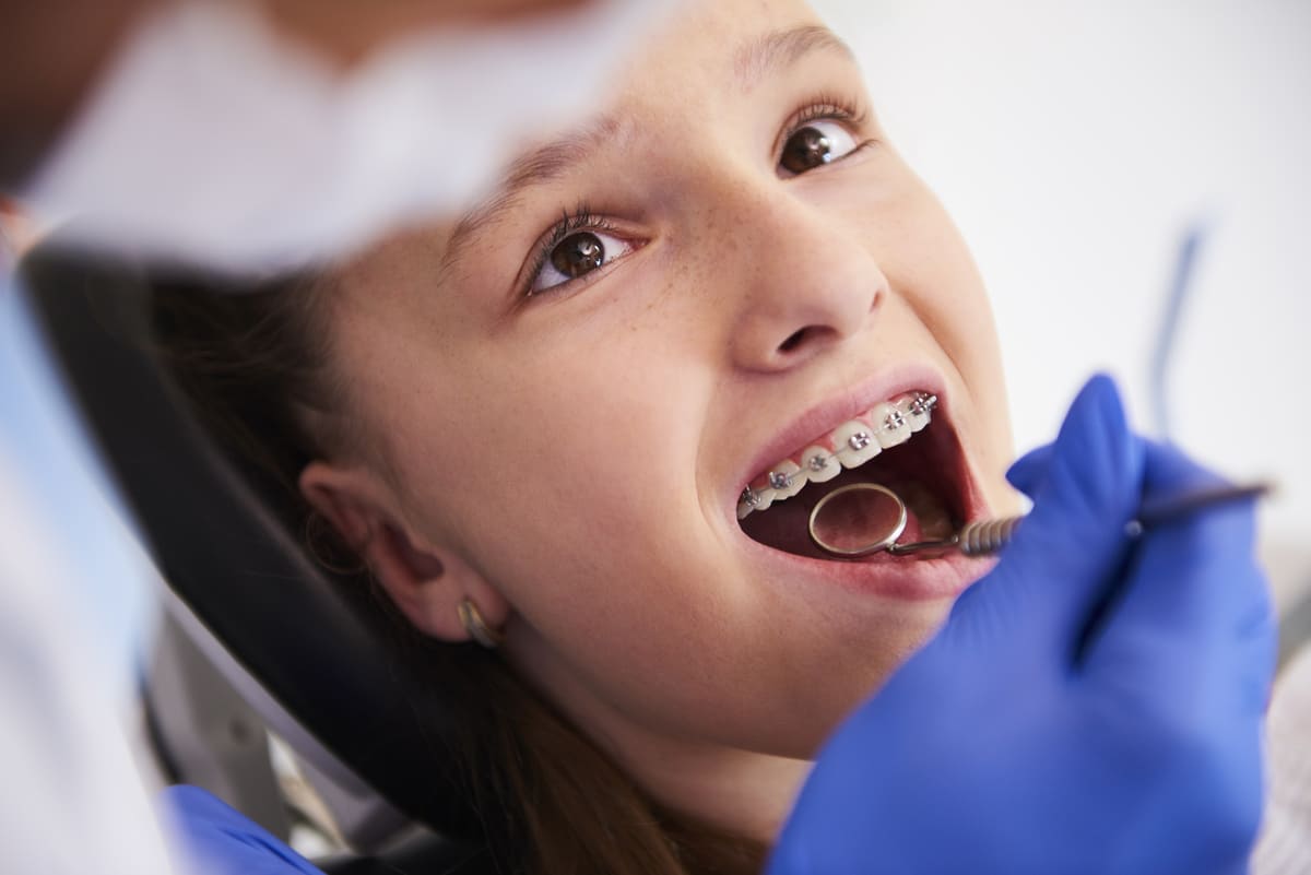brackets dientes leche